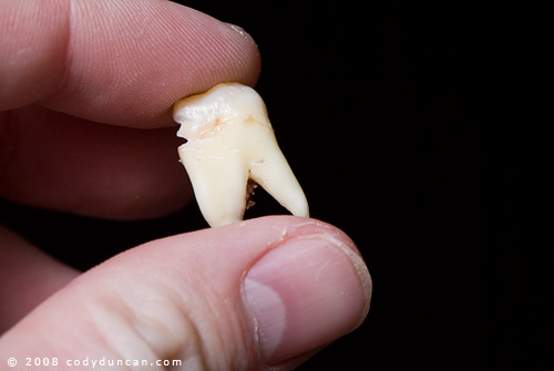 © 2008 cody duncan photography. Fingers holding wisdom tooth after being pulled by dentist